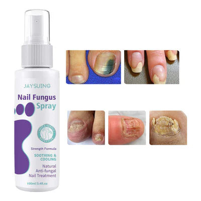 Spray de traitement des champignons des ongles