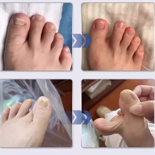 Spray de traitement des champignons des ongles